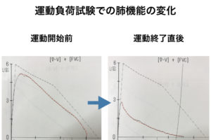 喘息の運動負荷試験を始めました！