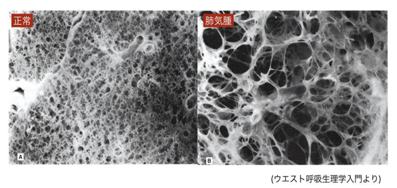 正常の肺と肺気腫の組織写真の比較。肺気腫では小さな部屋の壁が壊れて大きな空洞ができている