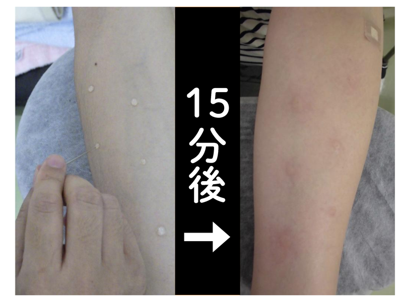 プリックテストの様子。試薬を付けた15分後に腕に膨疹が出ている