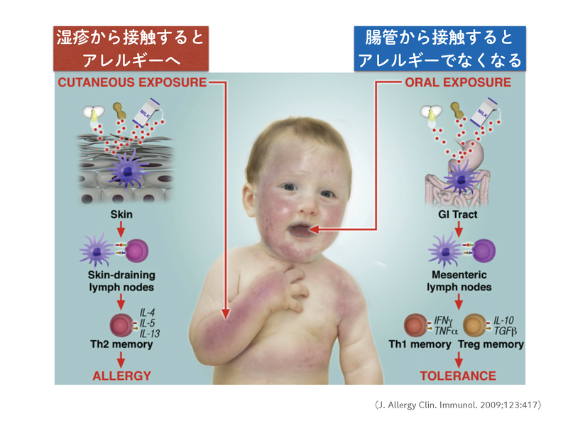 湿疹から食物に接触するとアレルギーになりやすく、腸管から接触するとアレルギーになりにくくなる仕組み